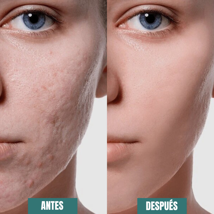 Zilva® Hojas de Silicona para Cicatrices y Arrugas x 3 Metros