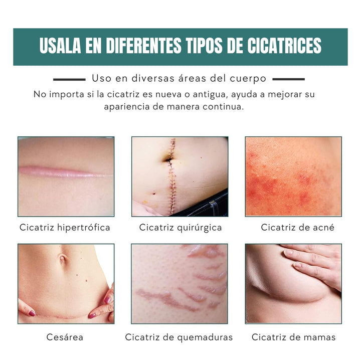 Zilva® Hojas de Silicona para Cicatrices y Arrugas x 3 Metros
